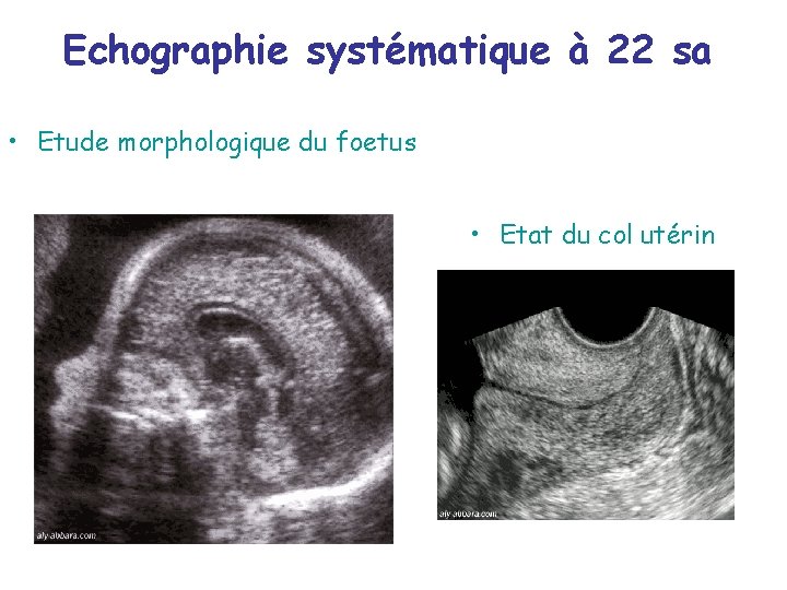 Echographie systématique à 22 sa • Etude morphologique du foetus • Etat du col