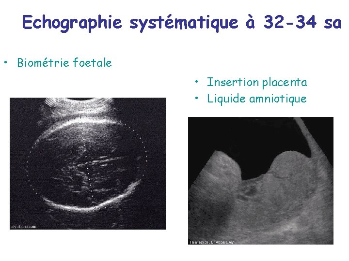 Echographie systématique à 32 -34 sa • Biométrie foetale • Insertion placenta • Liquide