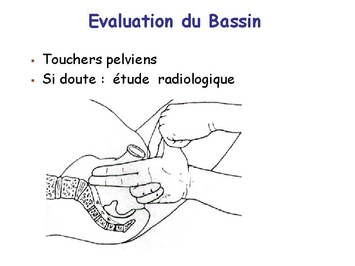 Evaluation du Bassin § § Touchers pelviens Si doute : étude radiologique 