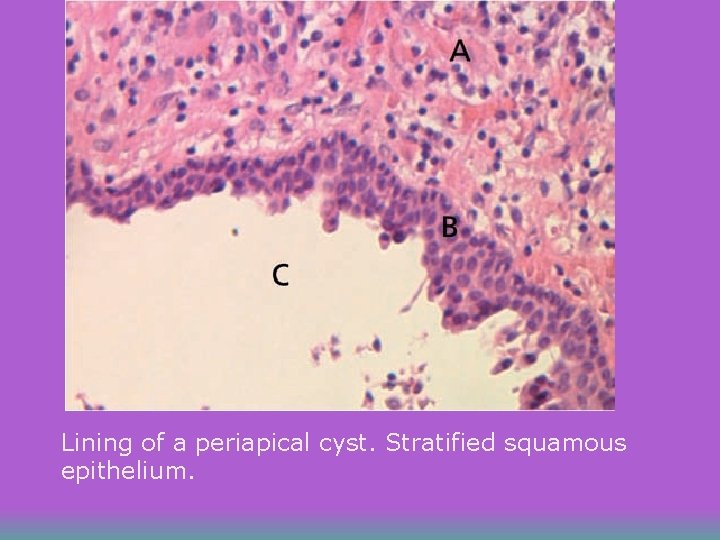 Lining of a periapical cyst. Stratified squamous epithelium. 