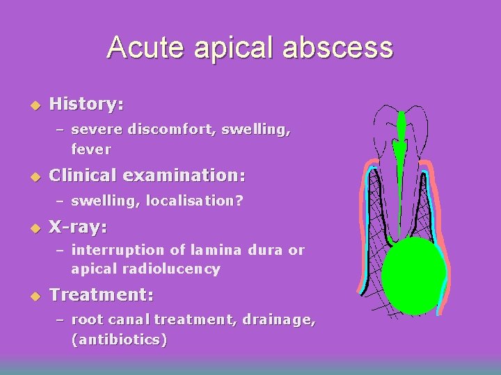 Acute apical abscess u History: – severe discomfort, swelling, fever u Clinical examination: –