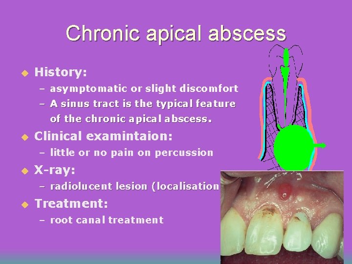 Chronic apical abscess u History: – asymptomatic or slight discomfort – A sinus tract