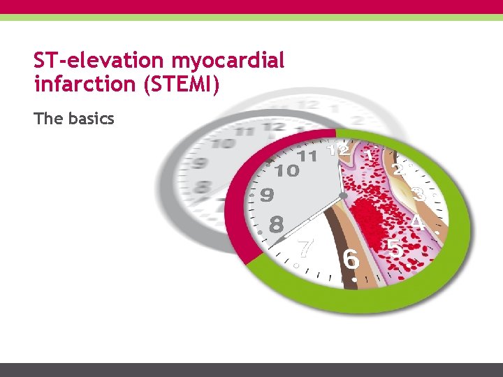 ST-elevation myocardial infarction (STEMI) The basics 