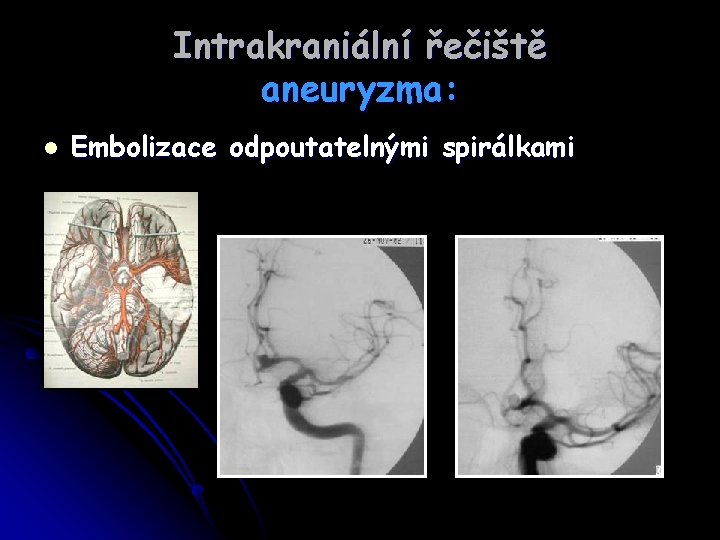 Intrakraniální řečiště aneuryzma: l Embolizace odpoutatelnými spirálkami 