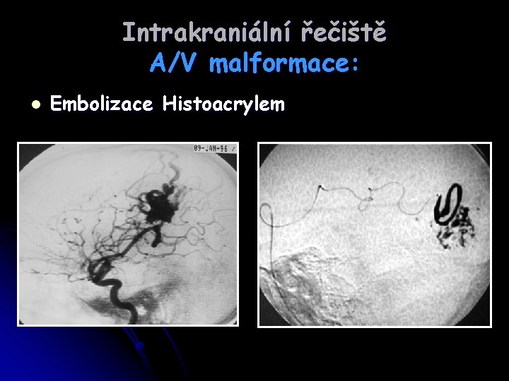 Intrakraniální řečiště A/V malformace: l Embolizace Histoacrylem 