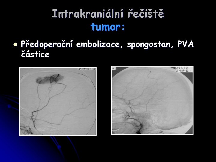 Intrakraniální řečiště tumor: l Předoperační embolizace, spongostan, PVA částice 