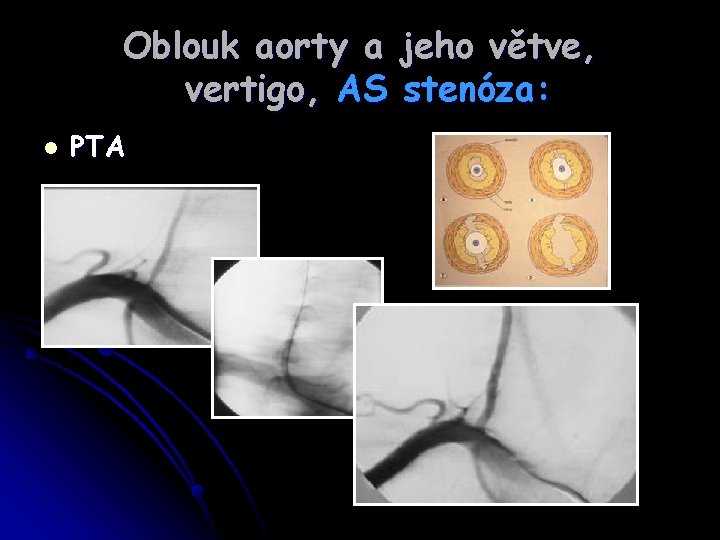 Oblouk aorty a jeho větve, vertigo, AS stenóza: l PTA 