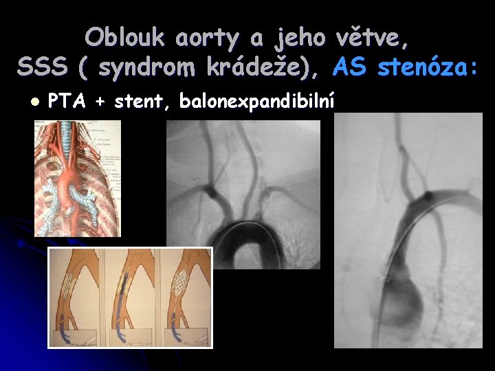 Oblouk aorty a jeho větve, SSS ( syndrom krádeže), AS stenóza: l PTA +