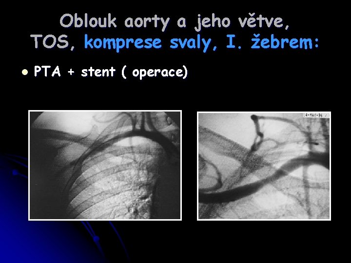 Oblouk aorty a jeho větve, TOS, komprese svaly, I. žebrem: l PTA + stent