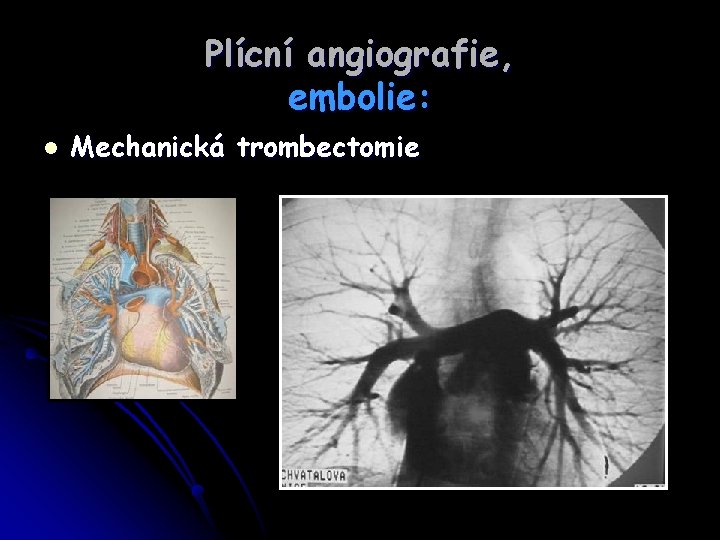 Plícní angiografie, embolie: l Mechanická trombectomie 