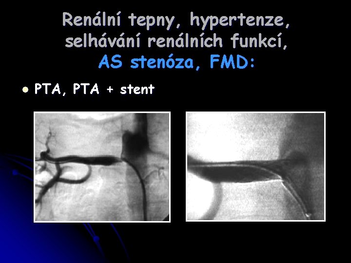 Renální tepny, hypertenze, selhávání renálních funkcí, AS stenóza, FMD: l PTA, PTA + stent