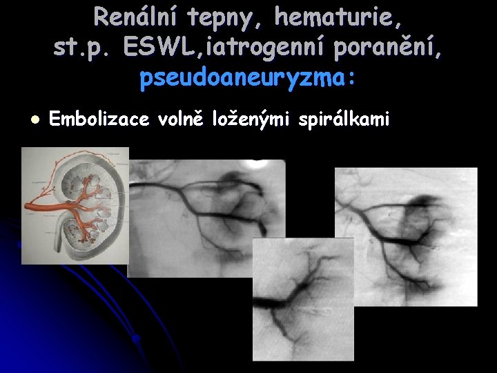 Renální tepny, hematurie, st. p. ESWL, iatrogenní poranění, pseudoaneuryzma: l Embolizace volně loženými spirálkami