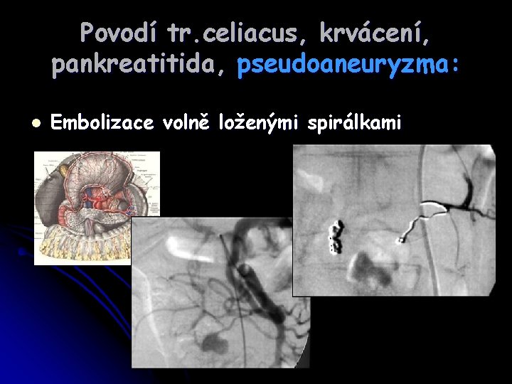 Povodí tr. celiacus, krvácení, pankreatitida, pseudoaneuryzma: l Embolizace volně loženými spirálkami 