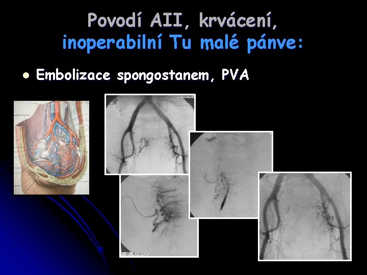 Povodí AII, krvácení, inoperabilní Tu malé pánve: l Embolizace spongostanem, PVA 