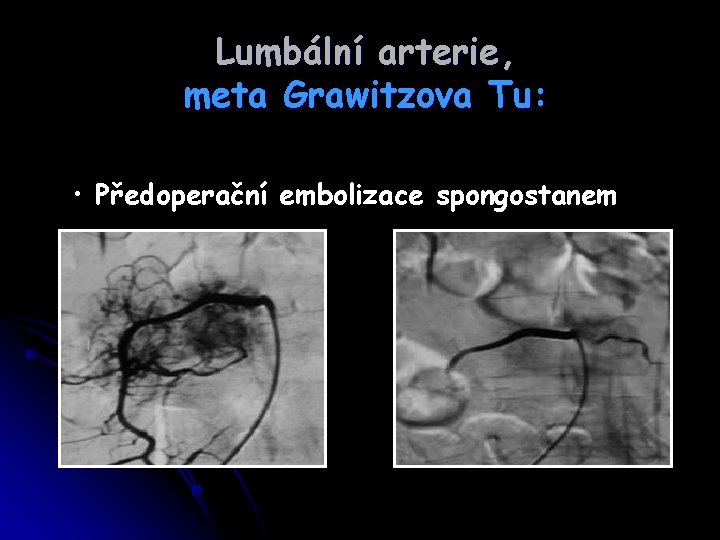 Lumbální arterie, meta Grawitzova Tu: • Předoperační embolizace spongostanem 
