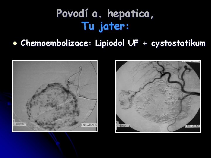 Povodí a. hepatica, Tu jater: l Chemoembolizace: Lipiodol UF + cystostatikum 