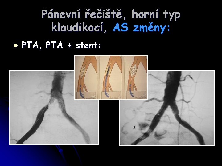 Pánevní řečiště, horní typ klaudikací, AS změny: l PTA, PTA + stent: 