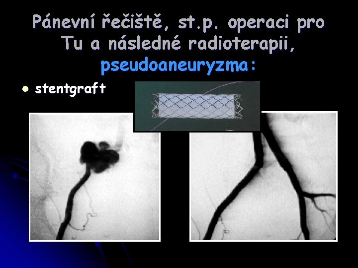 Pánevní řečiště, st. p. operaci pro Tu a následné radioterapii, pseudoaneuryzma: l stentgraft 