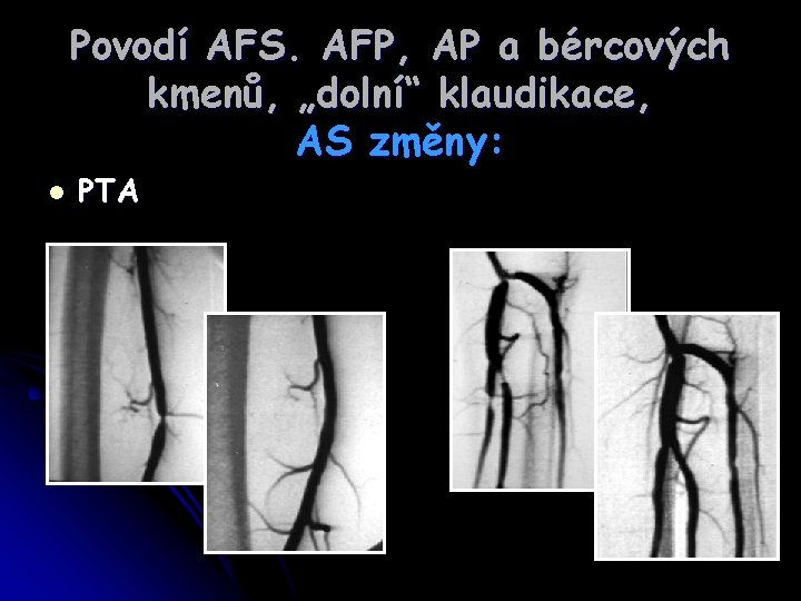 Povodí AFS. AFP, AP a bércových kmenů, „dolní“ klaudikace, AS změny: l PTA 