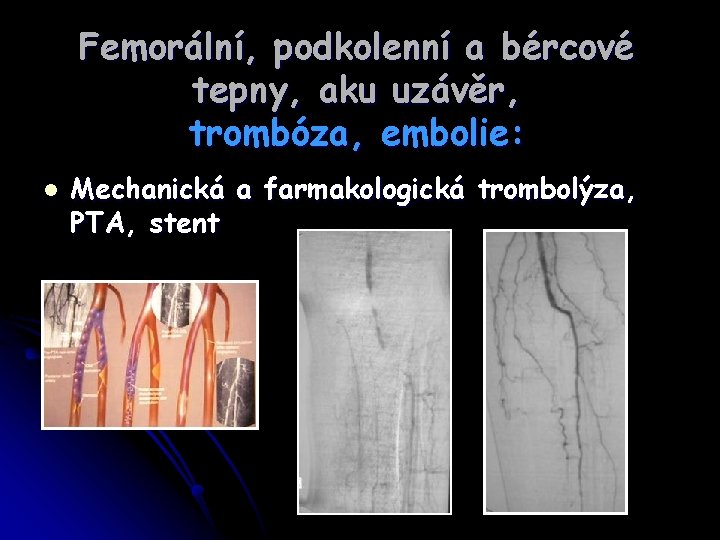 Femorální, podkolenní a bércové tepny, aku uzávěr, trombóza, embolie: l Mechanická a farmakologická trombolýza,