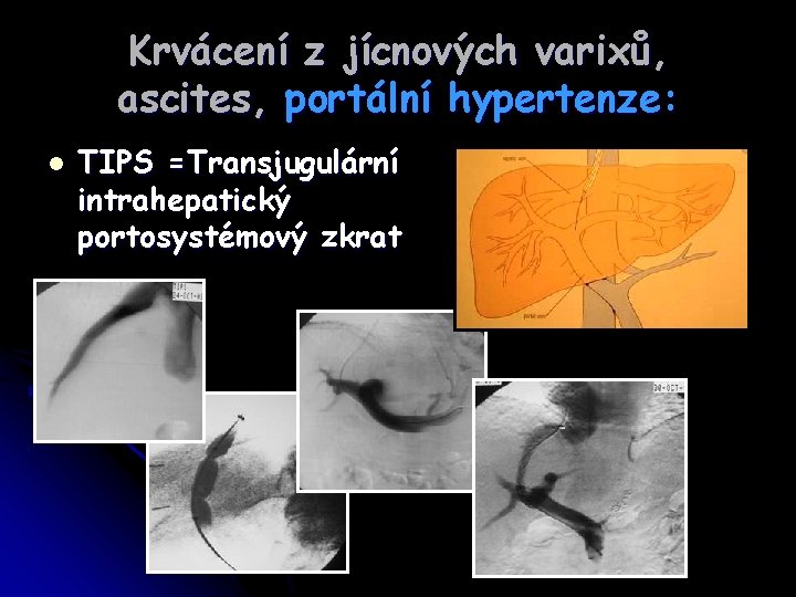 Krvácení z jícnových varixů, ascites, portální hypertenze: l TIPS =Transjugulární intrahepatický portosystémový zkrat 