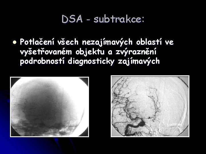 DSA - subtrakce: l Potlačení všech nezajímavých oblastí ve vyšetřovaném objektu a zvýraznění podrobností