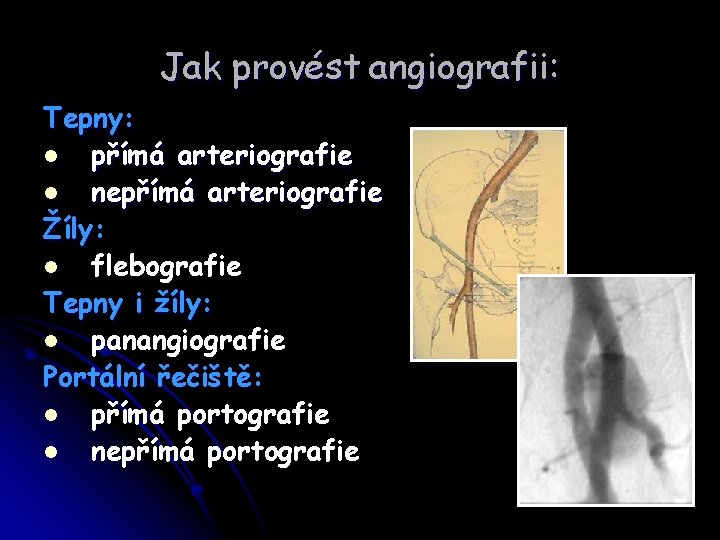 Jak provést angiografii: Tepny: l přímá arteriografie l nepřímá arteriografie Žíly: l flebografie Tepny