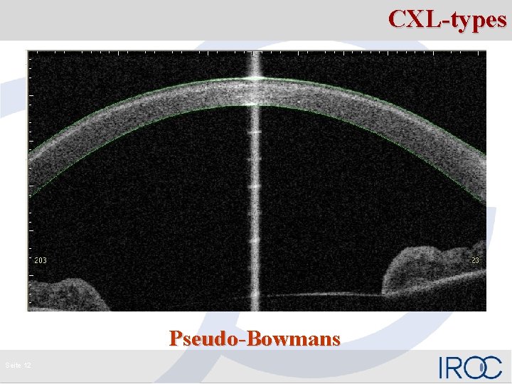 CXL-types Pseudo-Bowmans Seite 12 