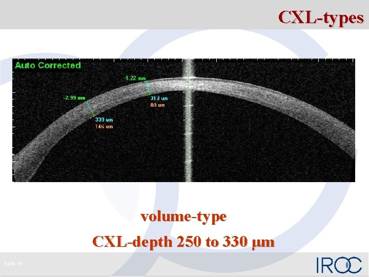 CXL-types volume-type CXL-depth 250 to 330 μm Seite 14 