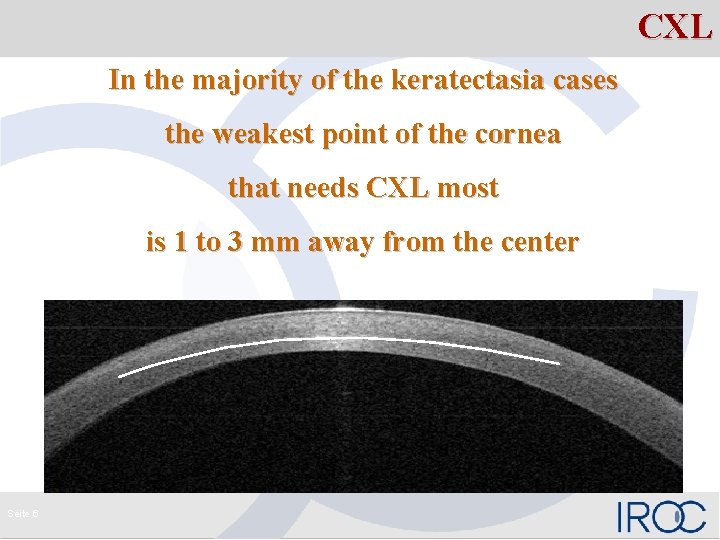 CXL In the majority of the keratectasia cases the weakest point of the cornea