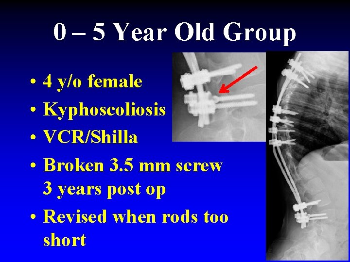 0 – 5 Year Old Group • • 4 y/o female Kyphoscoliosis VCR/Shilla Broken