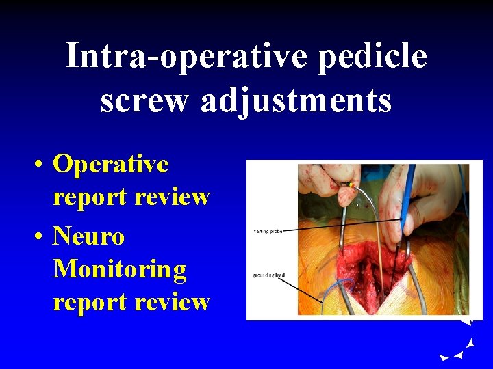 Intra-operative pedicle screw adjustments • Operative report review • Neuro Monitoring report review 