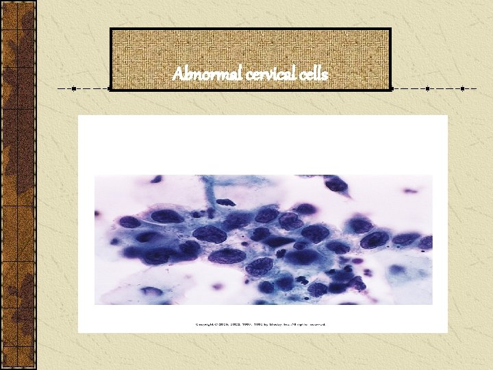 Abnormal cervical cells 