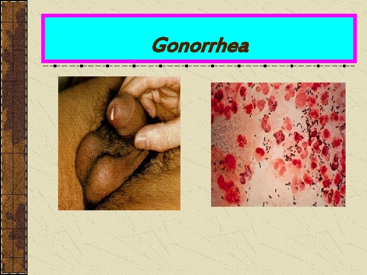 Gonorrhea 