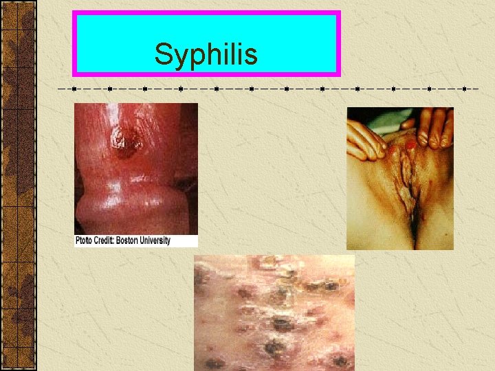 Syphilis 