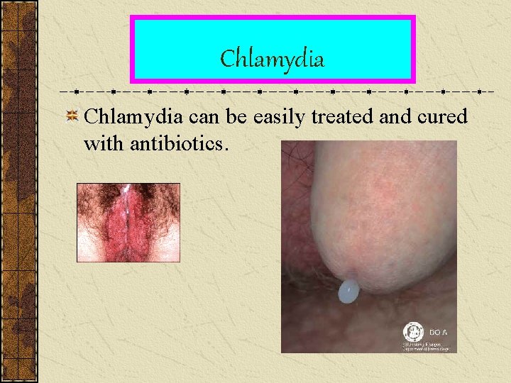 Chlamydia can be easily treated and cured with antibiotics. 