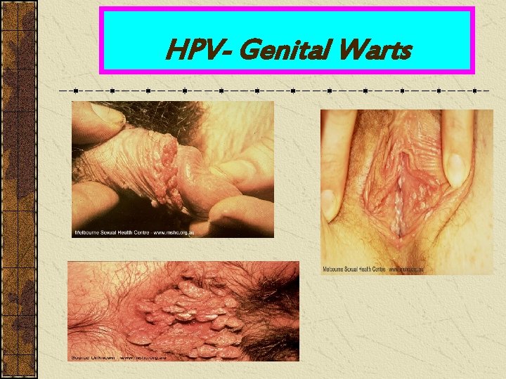 HPV- Genital Warts 