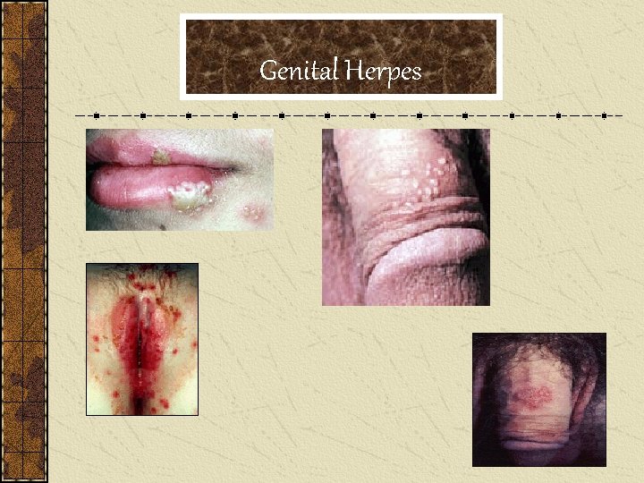 Genital Herpes 