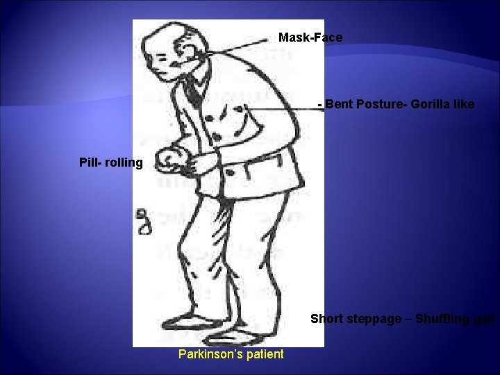 Mask-Face - Bent Posture- Gorilla like Pill- rolling Short steppage – Shuffling gait Parkinson’s