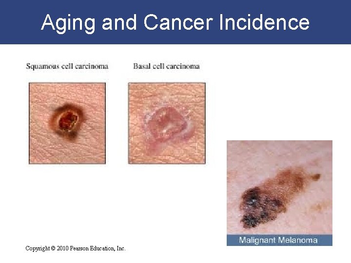Aging and Cancer Incidence Copyright © 2010 Pearson Education, Inc. 