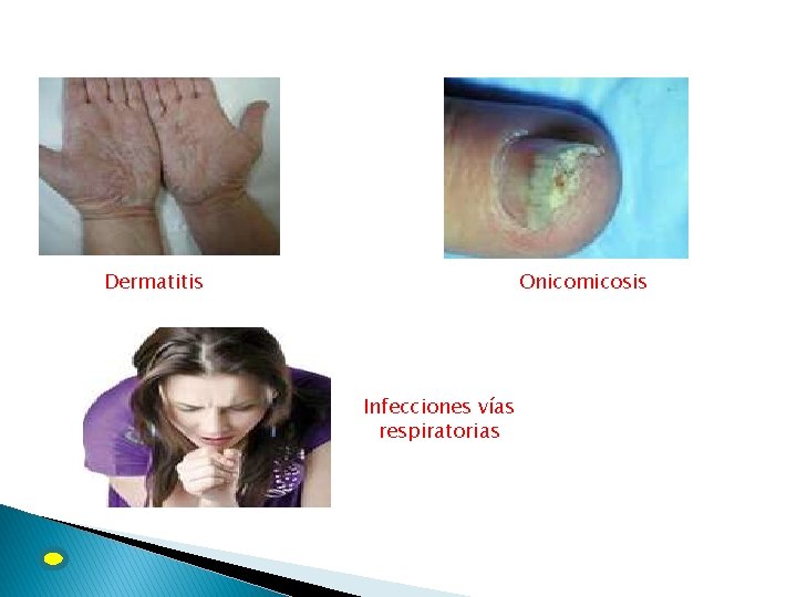 Dermatitis Onicomicosis Infecciones vías respiratorias 