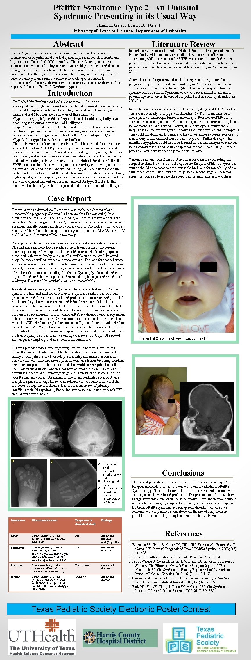 Pfeiffer Syndrome Type 2: An Unusual Syndrome Presenting in its Usual Way Hannah Grace