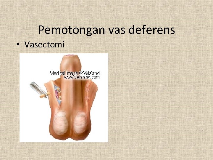 Pemotongan vas deferens • Vasectomi 