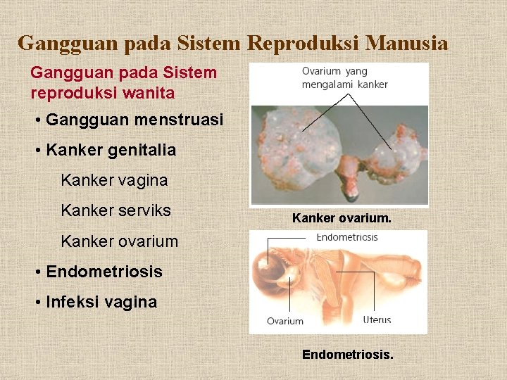 Gangguan pada Sistem Reproduksi Manusia Gangguan pada Sistem reproduksi wanita • Gangguan menstruasi •