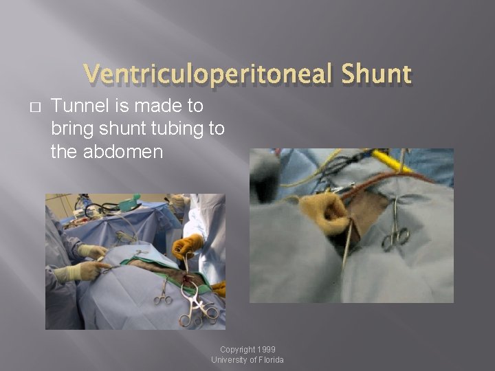 Ventriculoperitoneal Shunt � Tunnel is made to bring shunt tubing to the abdomen Copyright