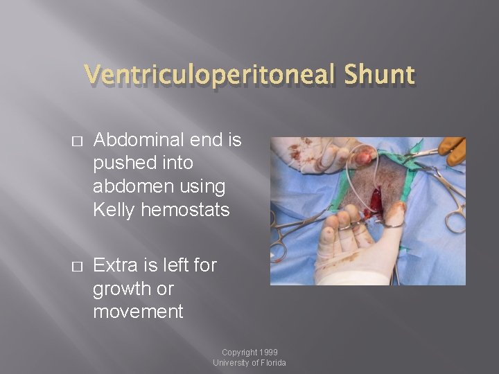 Ventriculoperitoneal Shunt � Abdominal end is pushed into abdomen using Kelly hemostats � Extra