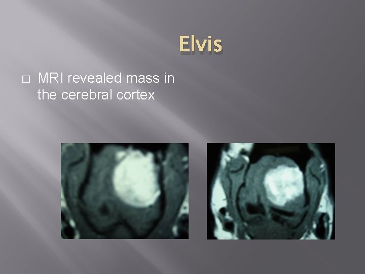 Elvis � MRI revealed mass in the cerebral cortex 