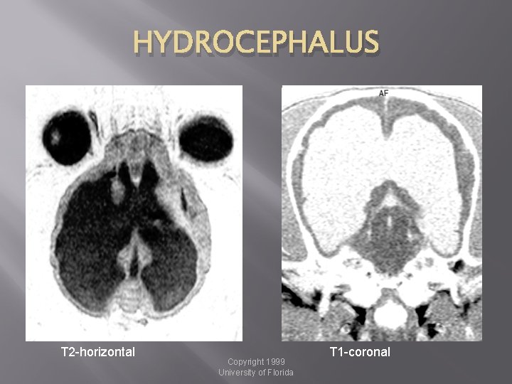 HYDROCEPHALUS T 2 -horizontal Copyright 1999 University of Florida T 1 -coronal 