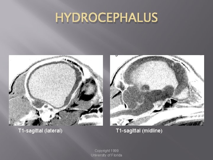 HYDROCEPHALUS T 1 -sagittal (lateral) T 1 -sagittal (midline) Copyright 1999 University of Florida