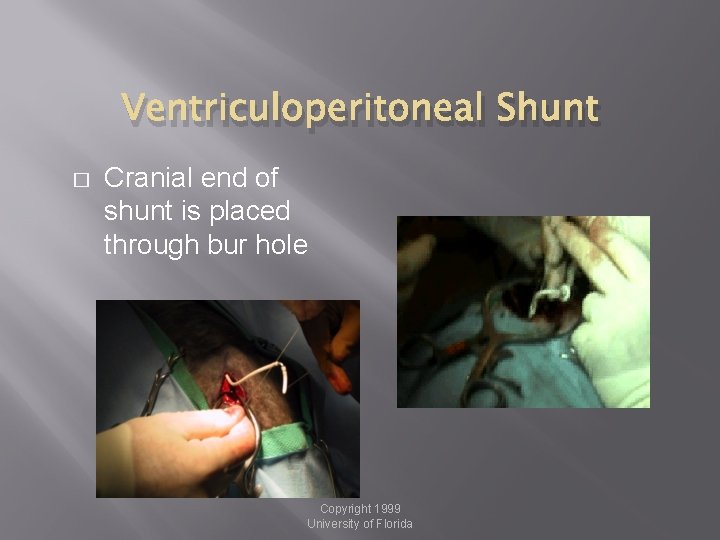 Ventriculoperitoneal Shunt � Cranial end of shunt is placed through bur hole Copyright 1999